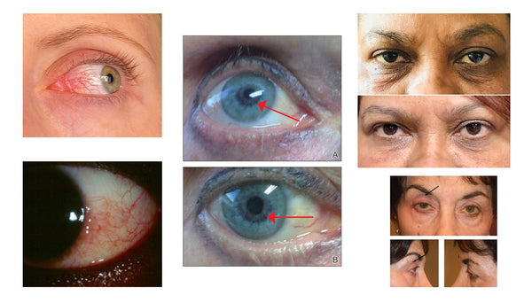 Side effects of prostaglandin based lash serums like Latisse can cause sunken eye syndrome