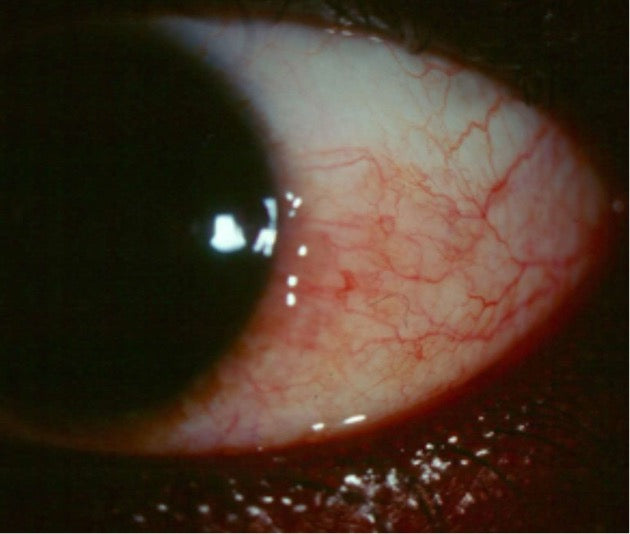 Extreme close-up of dilated conjunctival blood vessels, illustrating prostaglandin-mediated vasodilation