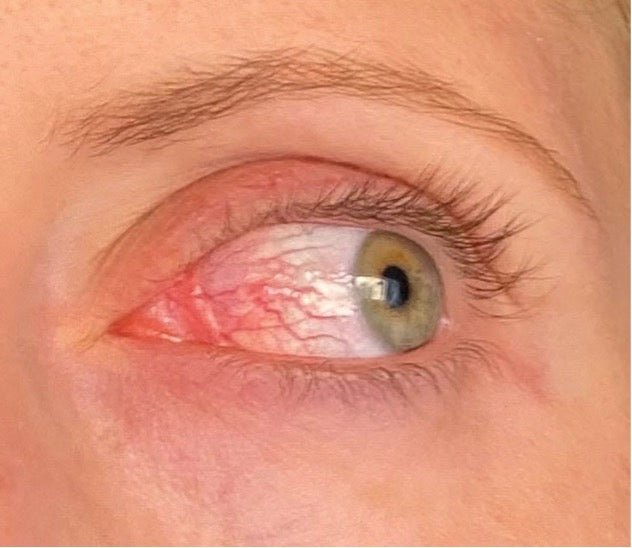Close-up of an eye showing severe conjunctival hyperemia (redness and visible blood vessels), a documented side effect of Latisse