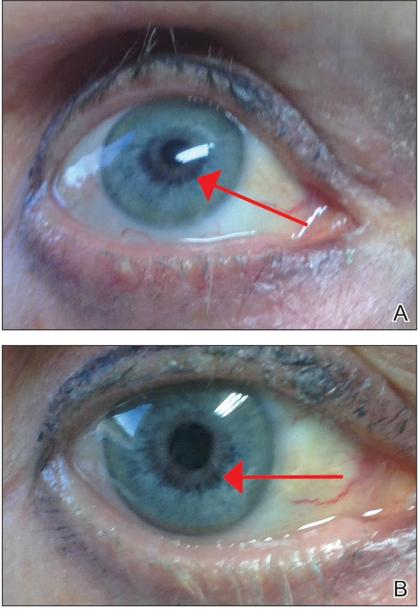 Two panels (A and B) showing iris hyperpigmentation in a Latisse user, increased brown pigmentation around the pupil indicated by red arrows