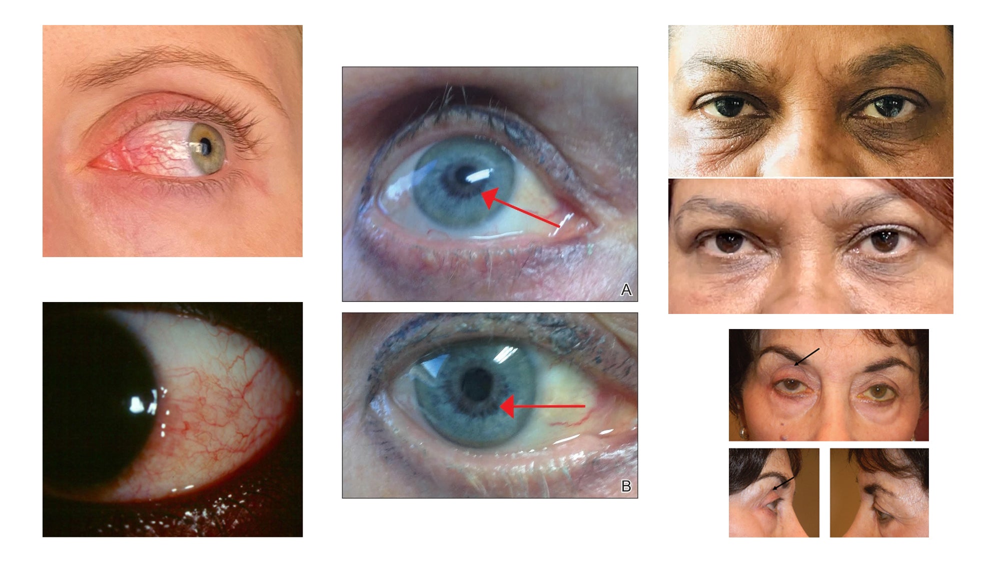 Composite of documented Latisse side effects: conjunctival hyperemia, iris pigmentation change with red arrows, periorbital darkening, and prostaglandin-associated periorbitopathy