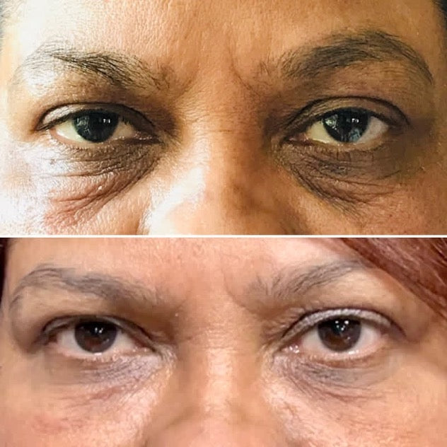 Two examples of periorbital hyperpigmentation (panda eyes) in users of prostaglandin lash serums, darkening of the eyelid skin extending beyond the application area