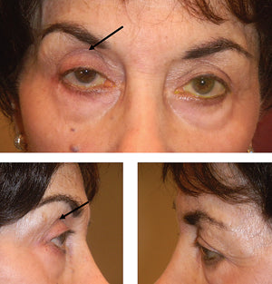 Multi-panel clinical photograph showing prostaglandin-associated periorbitopathy: deepened upper eyelid sulcus, sunken-eye appearance, and structural changes around the orbit