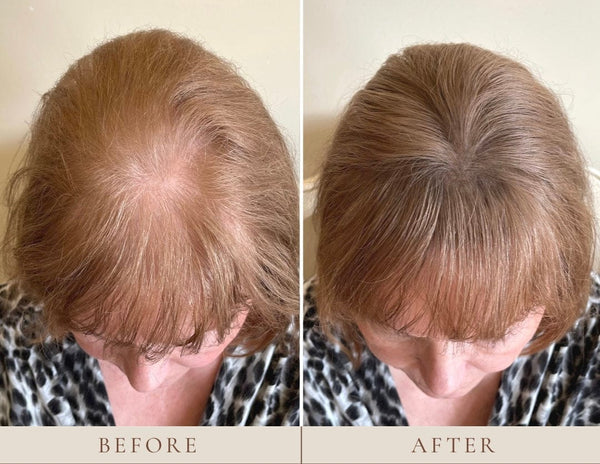 Instant Hairline Scalp-stick For Women