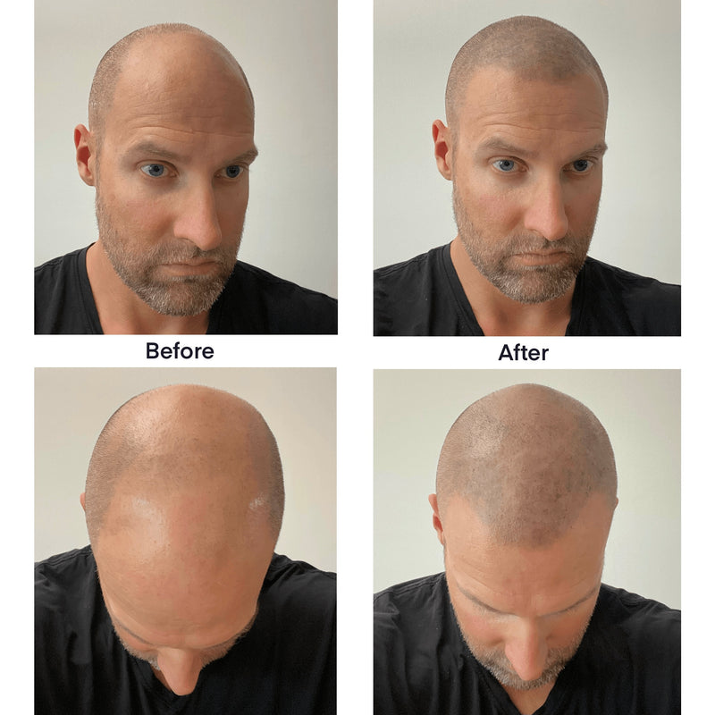 Instant Hairline Scalp-stick